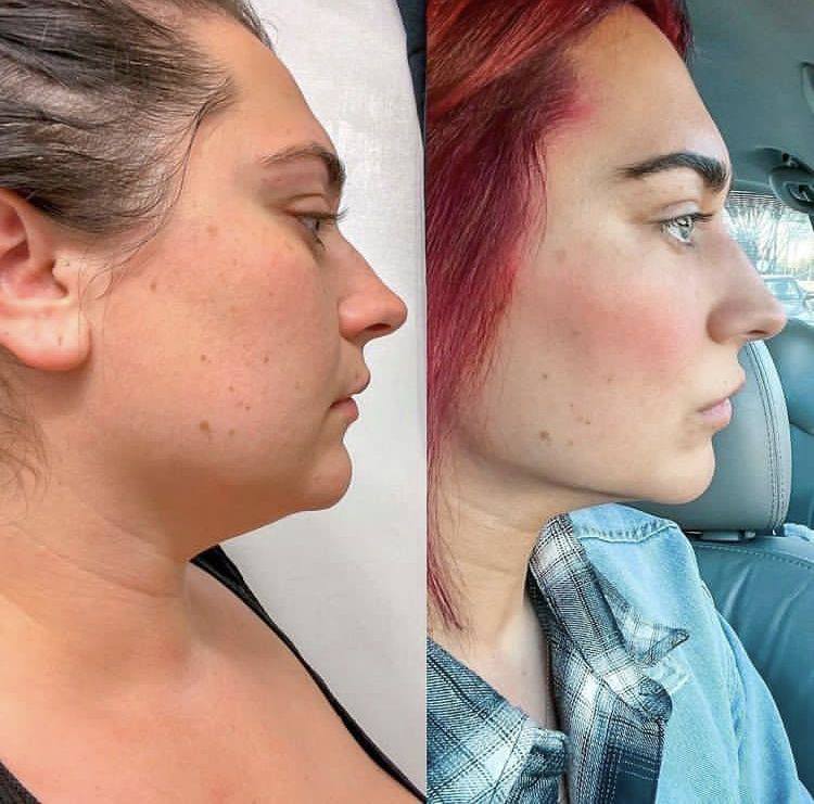 Ova™ Patches Double Cleanse Bundle